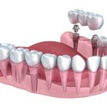Dental Implants vs. Bridges Kennesaw, GA