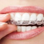 Invisalign: Safe, Conservative, Cosmetic Dentistry Kennesaw, GA